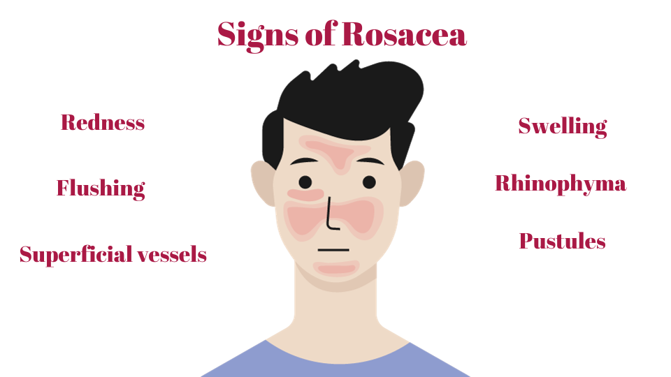 Common Causes of Rosacea