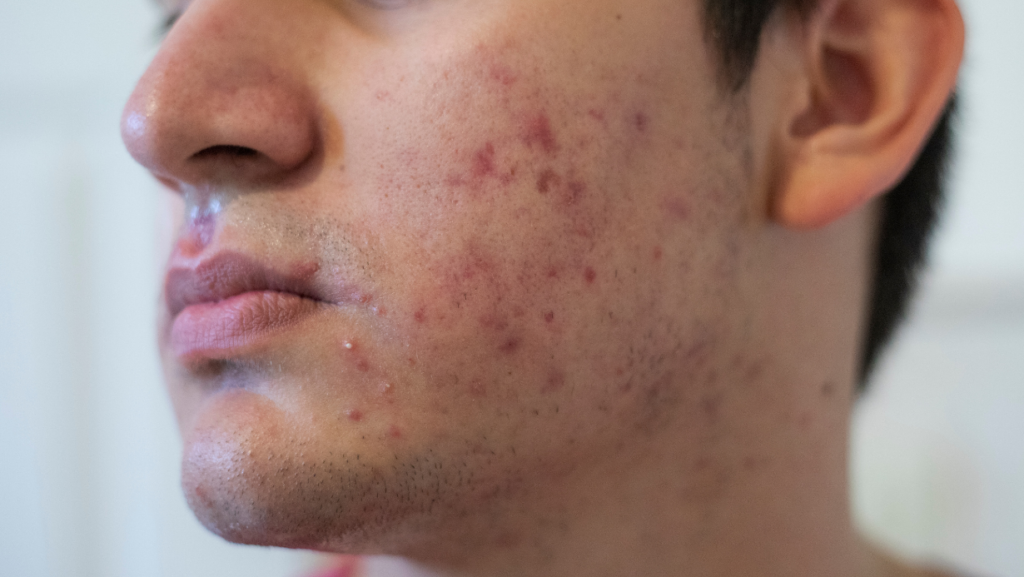 Online Accutane for Severe Acne
