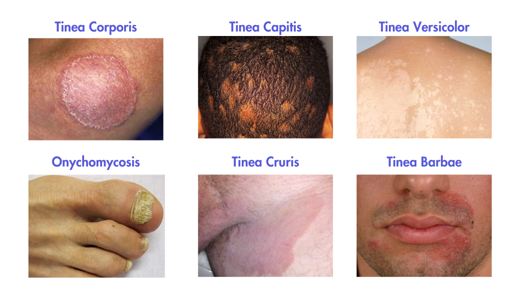 Skin fungal infections