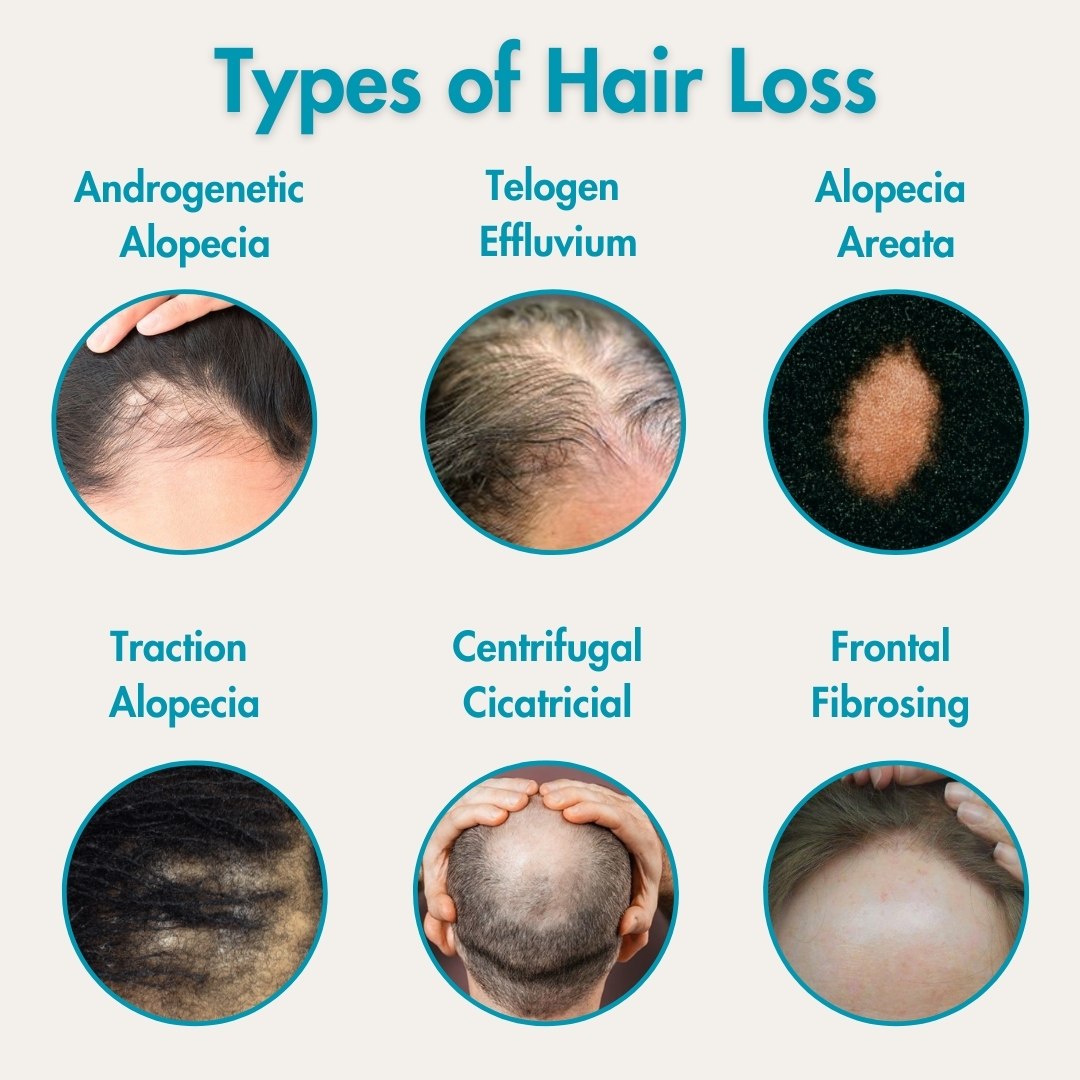 Types of Hair Loss