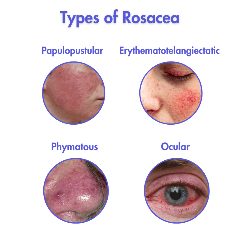 Types of Rosacea