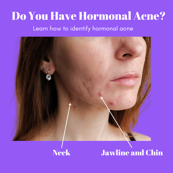 Cystic Acne Chin And Forehead