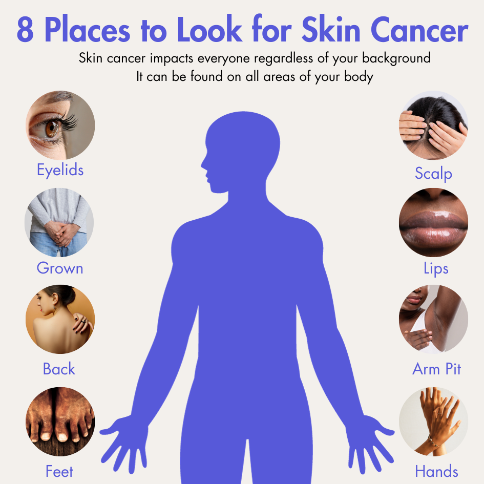 skin cancer body check