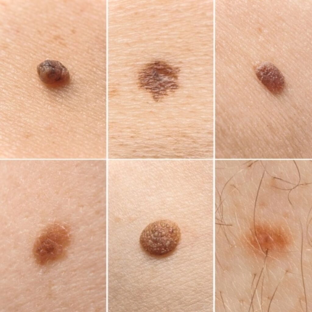 intradermal-nevus-understanding-the-common-skin-growth