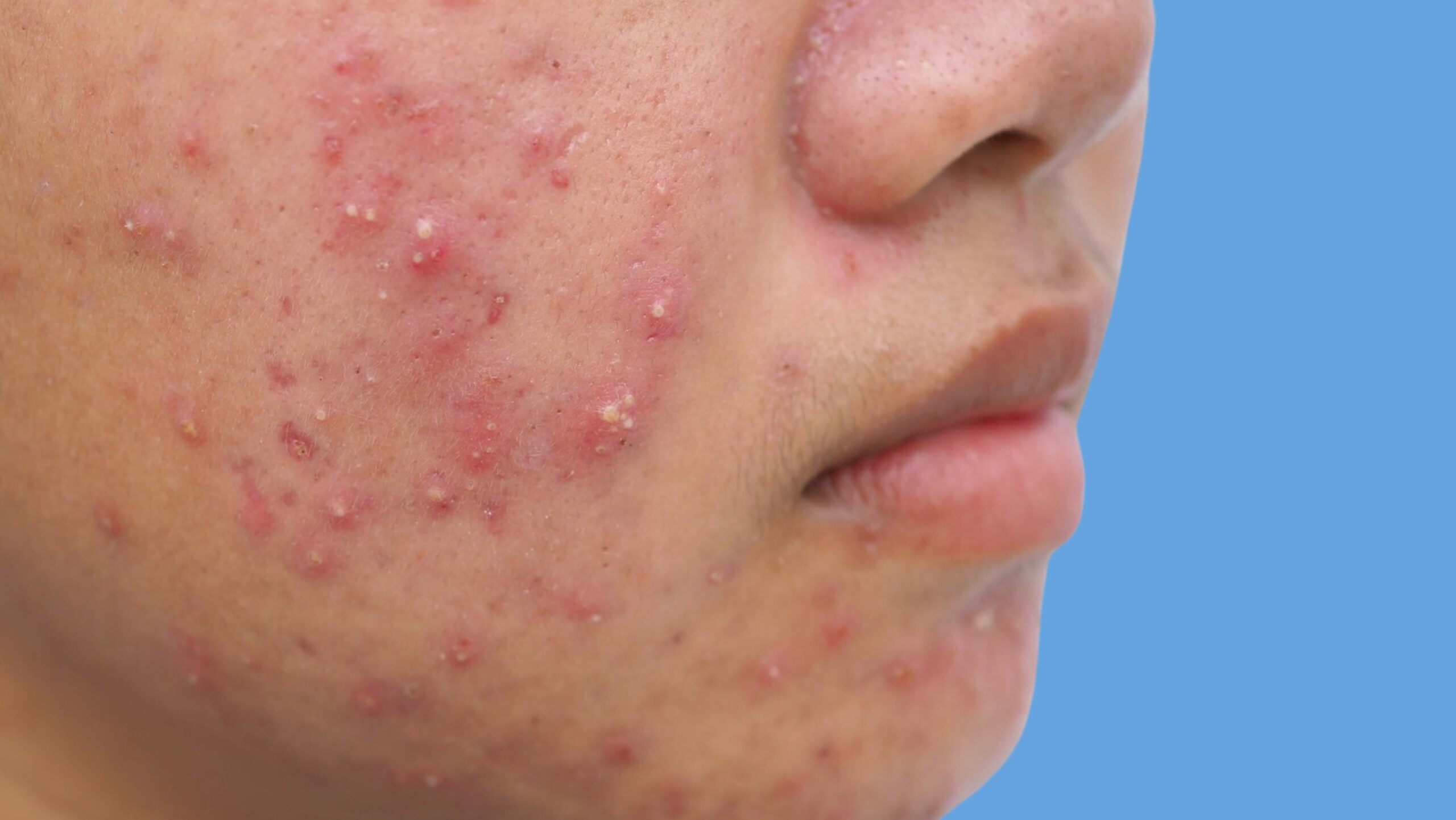 Hormonal Cyst Acne On Chin