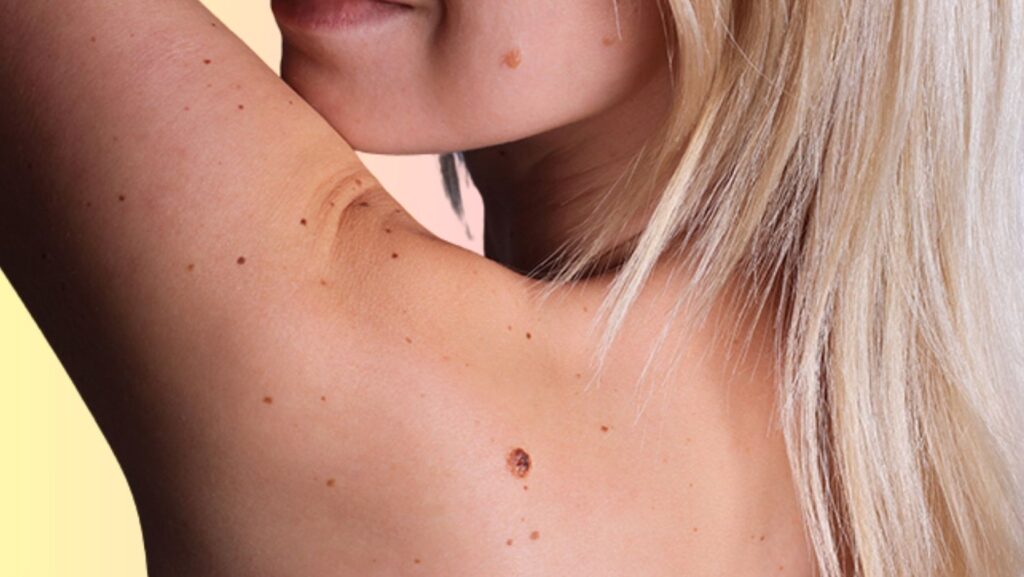 intradermal pigmented nevus