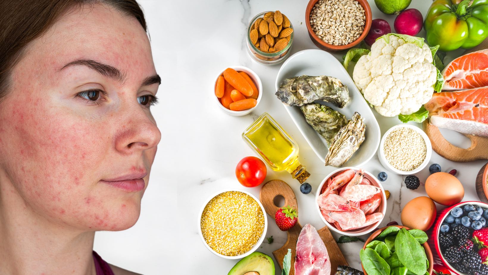 rosacea diet