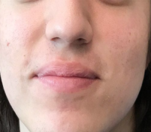severe acne after
