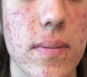 severe acne before