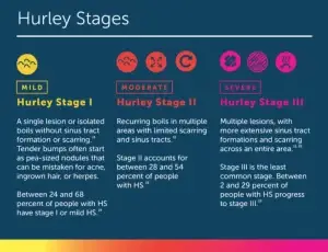 Hurley Stages