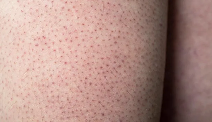 Keratosis Pilaris Arm