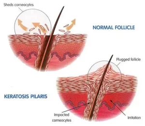 Keratosis Pilaris Drawing