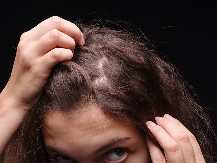 Trichotillomania