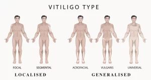 Vitiligo Subtypes