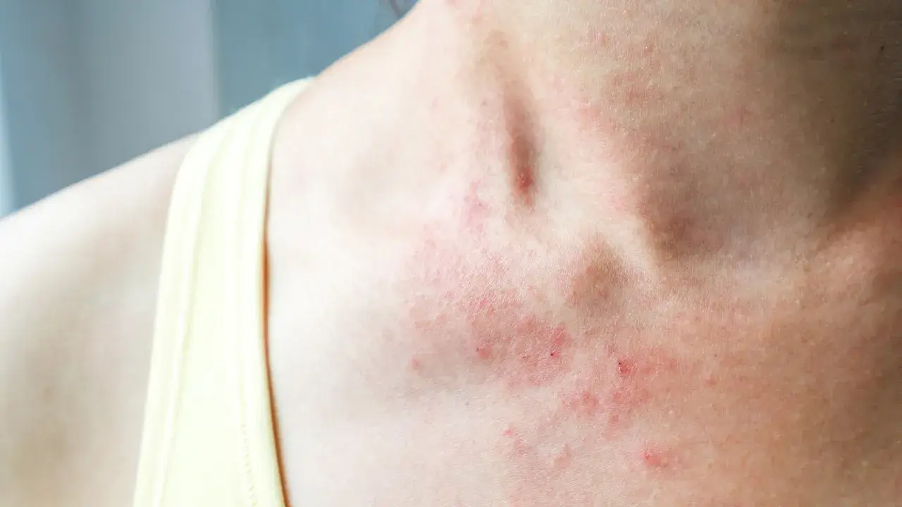 eczema treatment