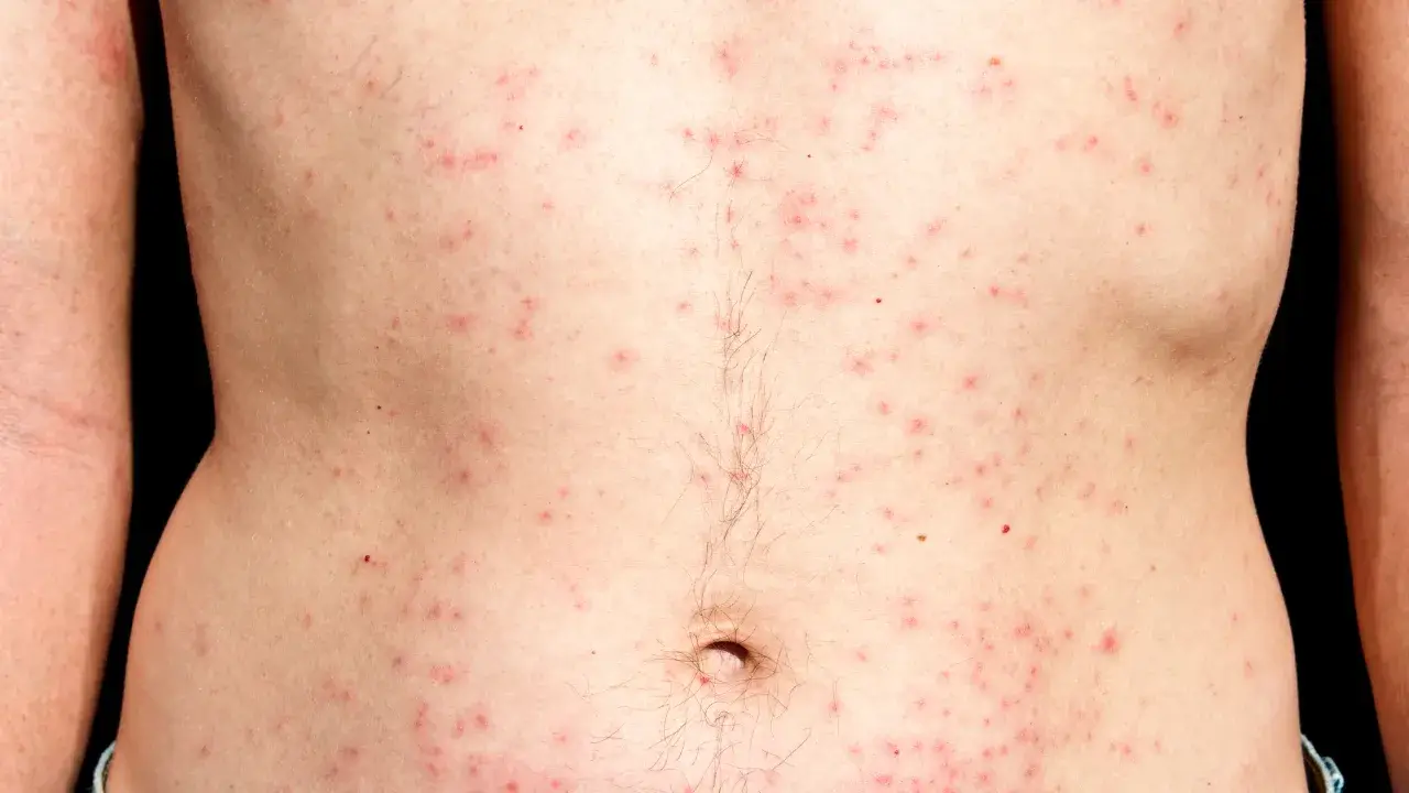 folliculitis treatment