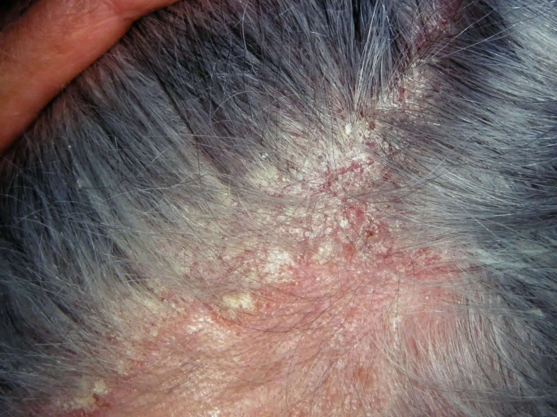 Seborrheic Dermatitis 1