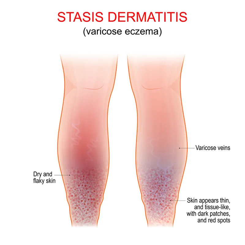 Everything You Need To Know About Stasis Dermatitis DermOnDemand