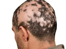 Alopecia Areata