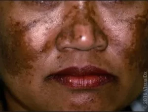 Melasma 1