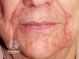 Periorificial dermatitis 3 