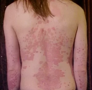 Psoriasis 1