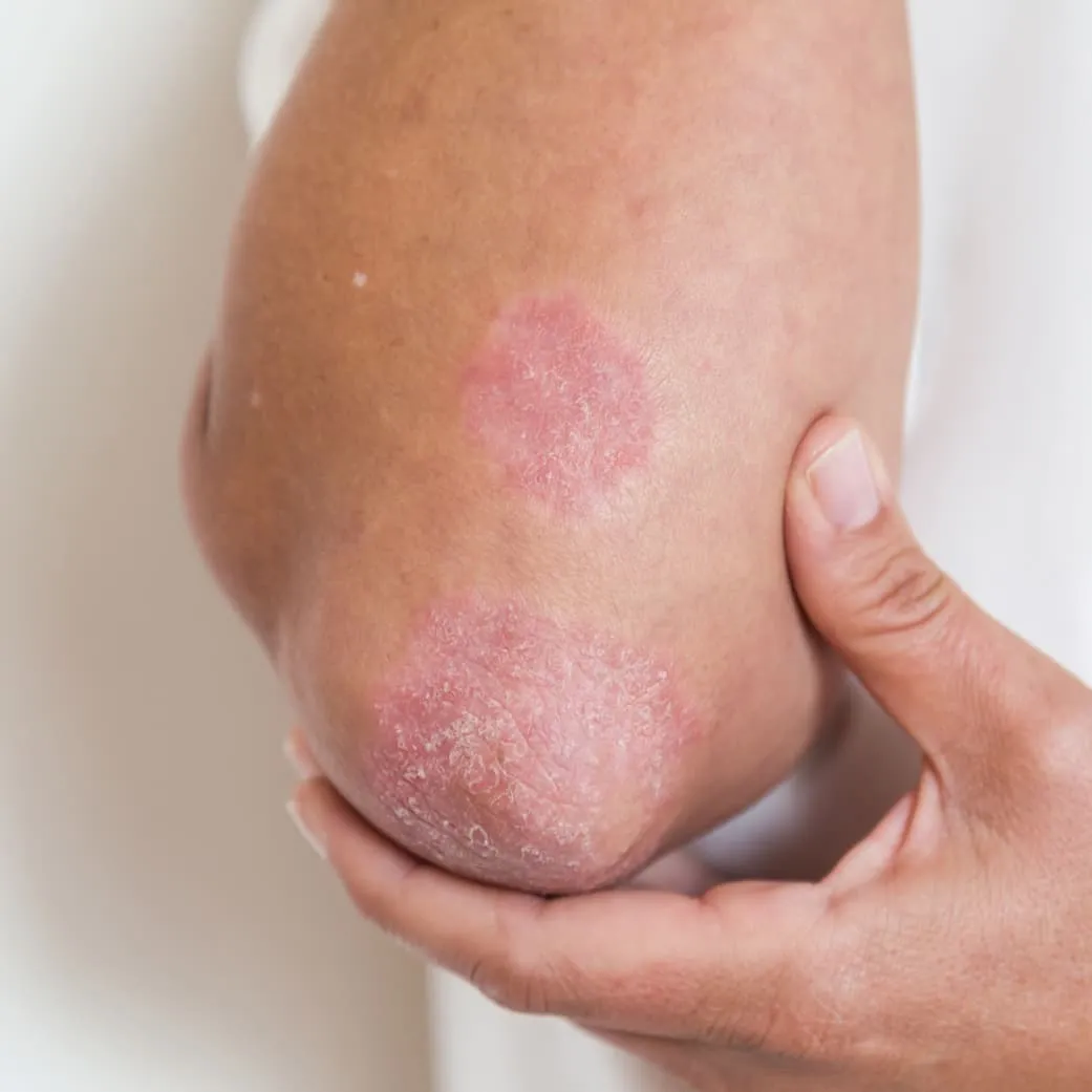 Psoriasis 2