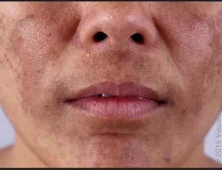 Melasma