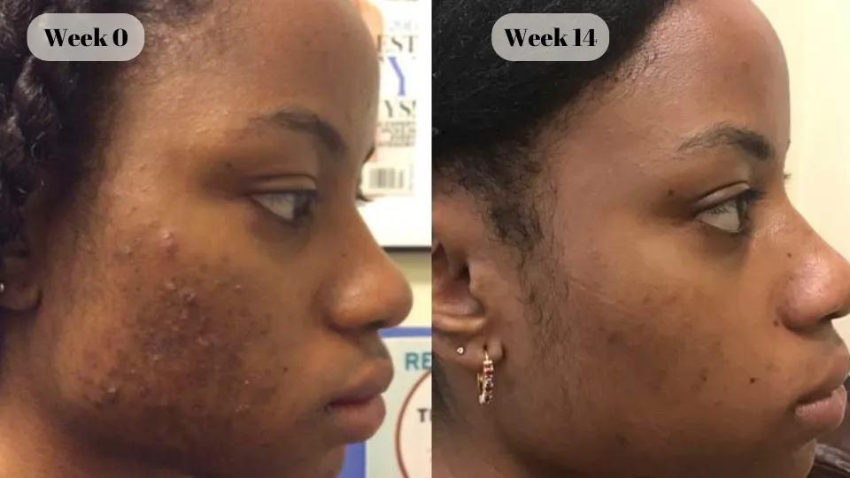 black female acne before and after