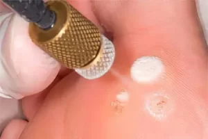 Cryotherapy treatment being performed on the skin