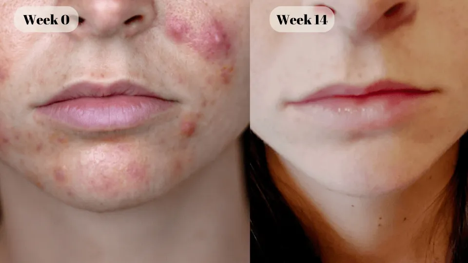 cystic acne before and after