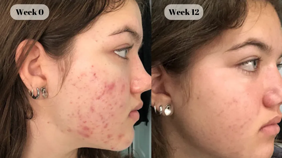 female cystic acne before and after