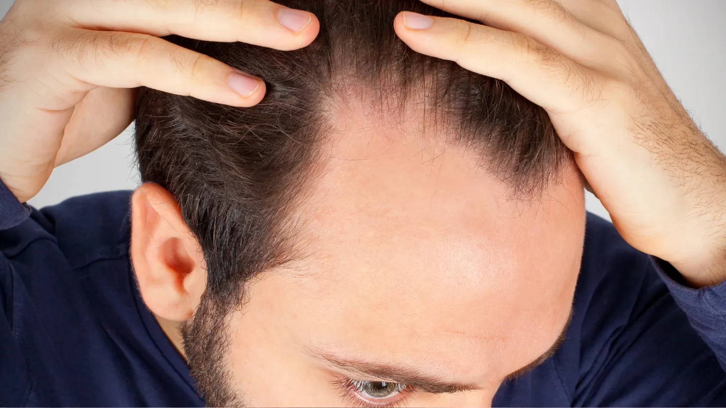 hair loss treatments