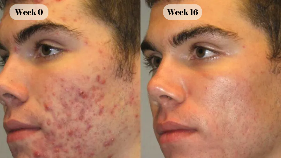 male acne before and after