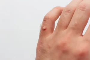 wart 4