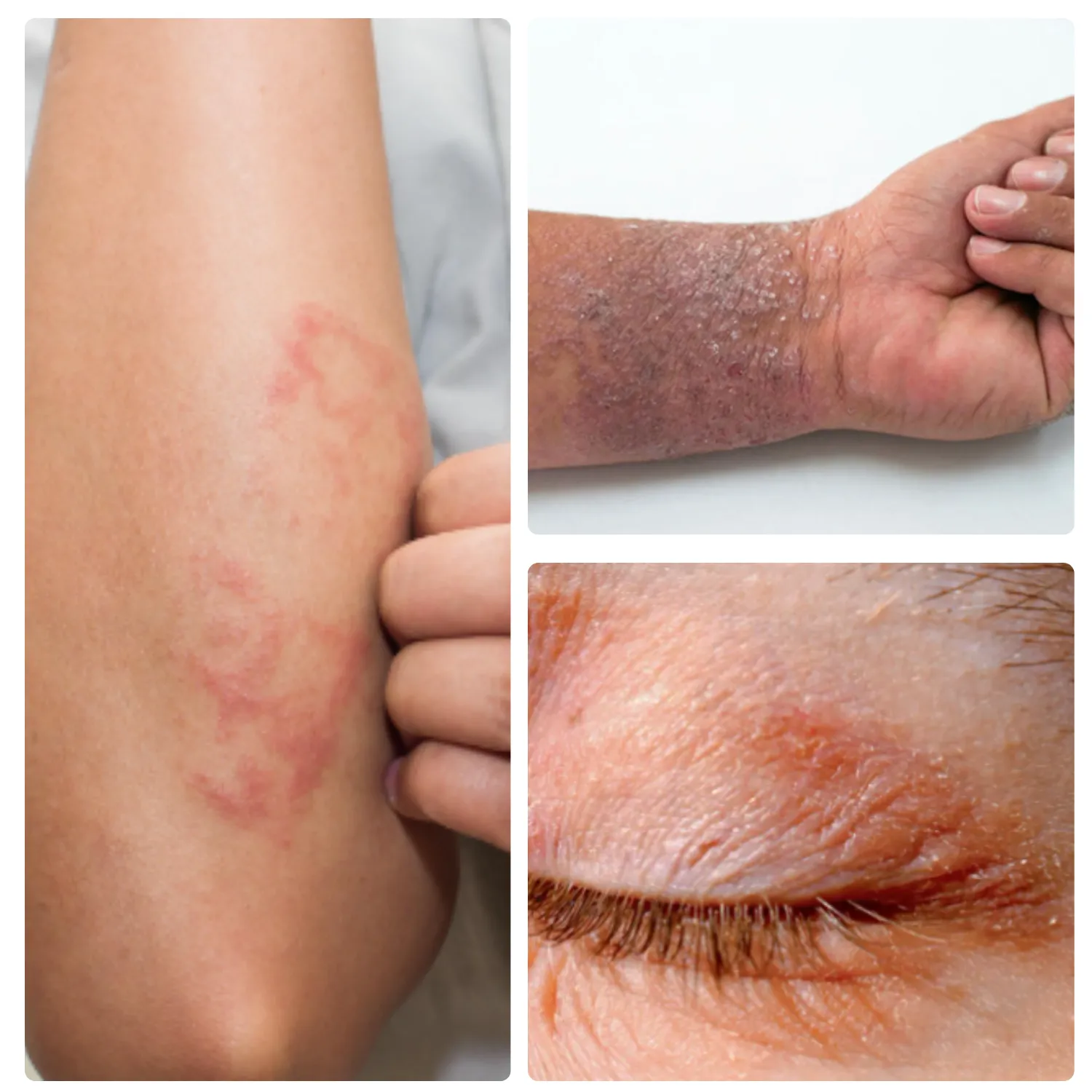 Eczema Treatments