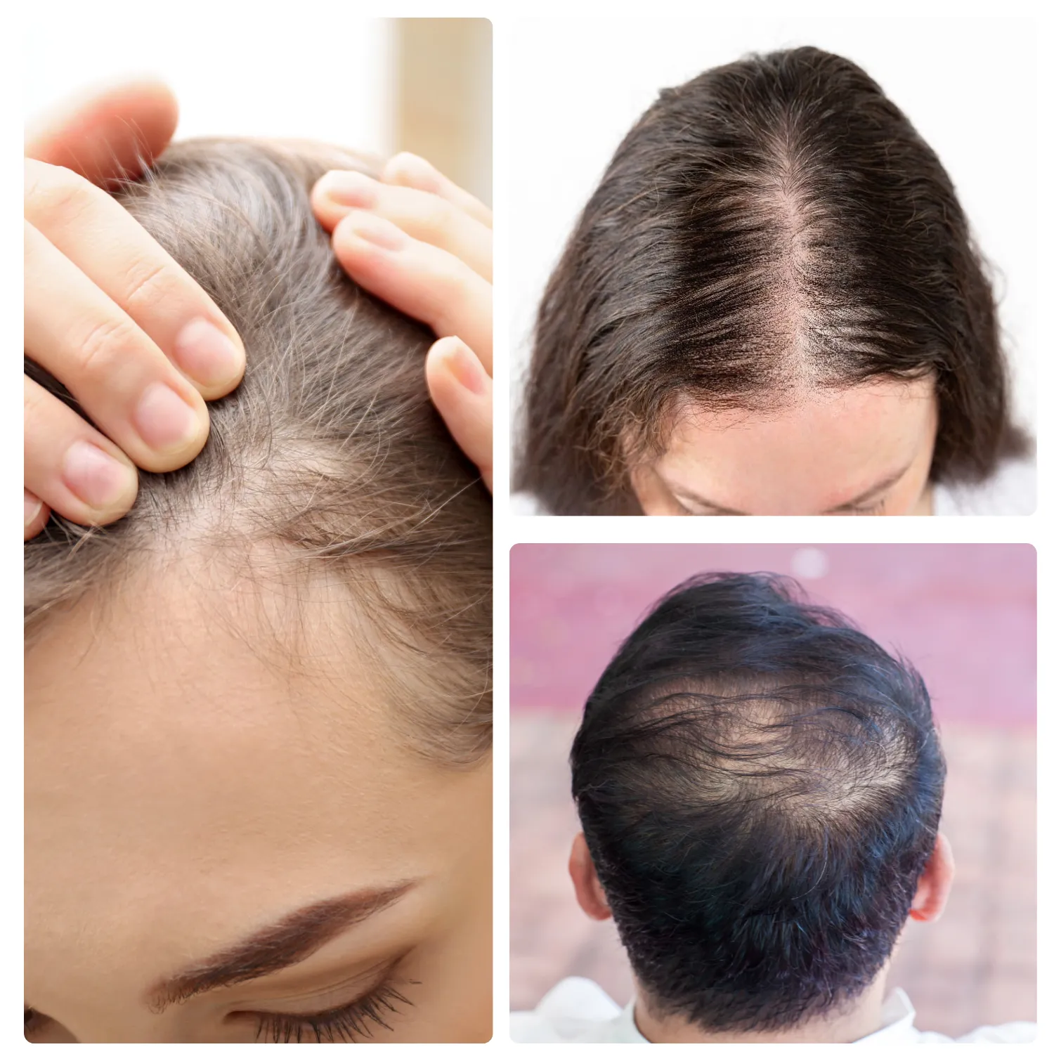 Hair Loss Treatments