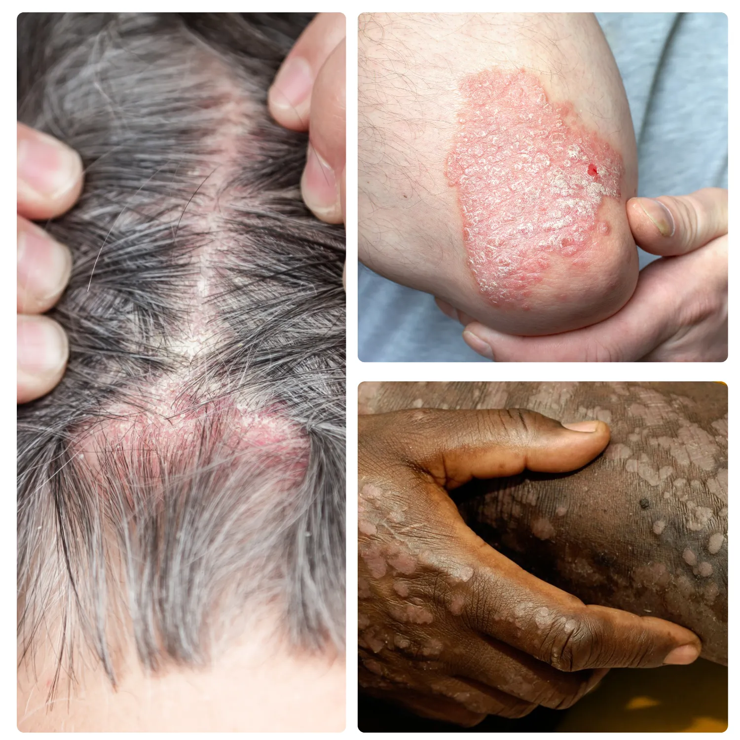 Psoriasis treatments