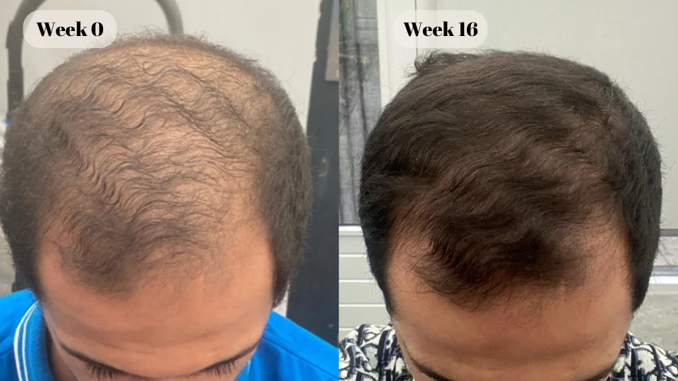 dutasteride before and after (3)