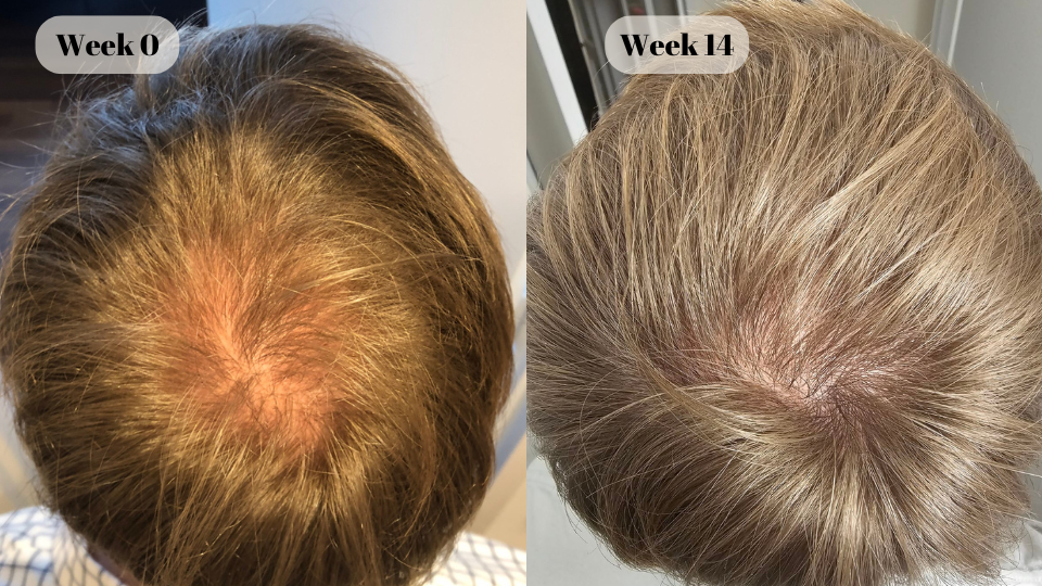 dutasteride before and after (5)
