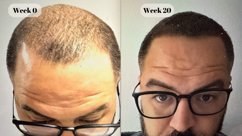 dutasteride before and after