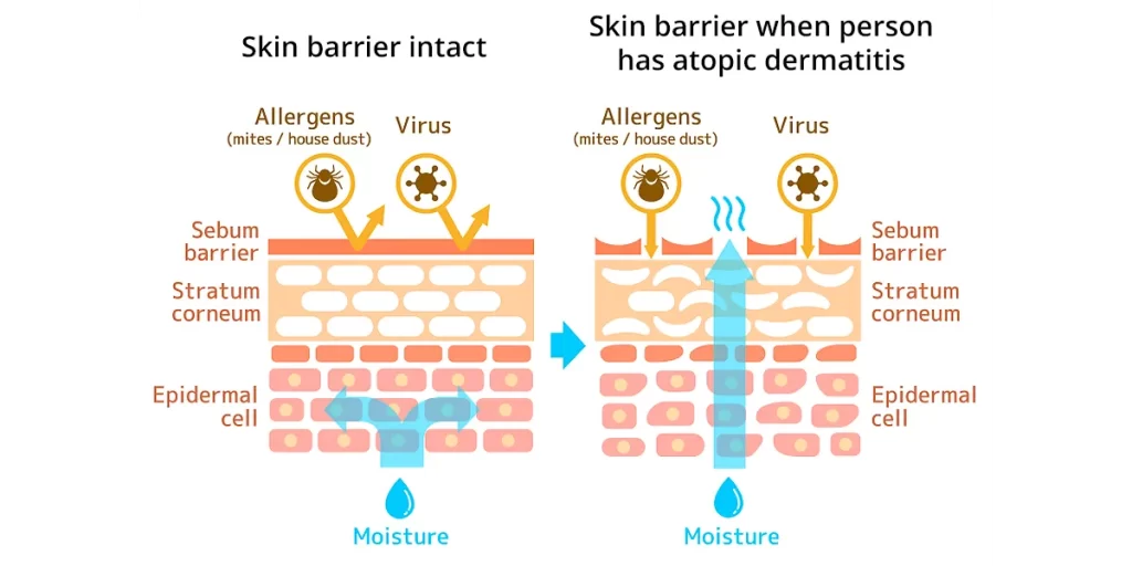 eczema farcas 1