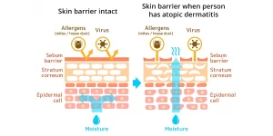 eczema farcas 1