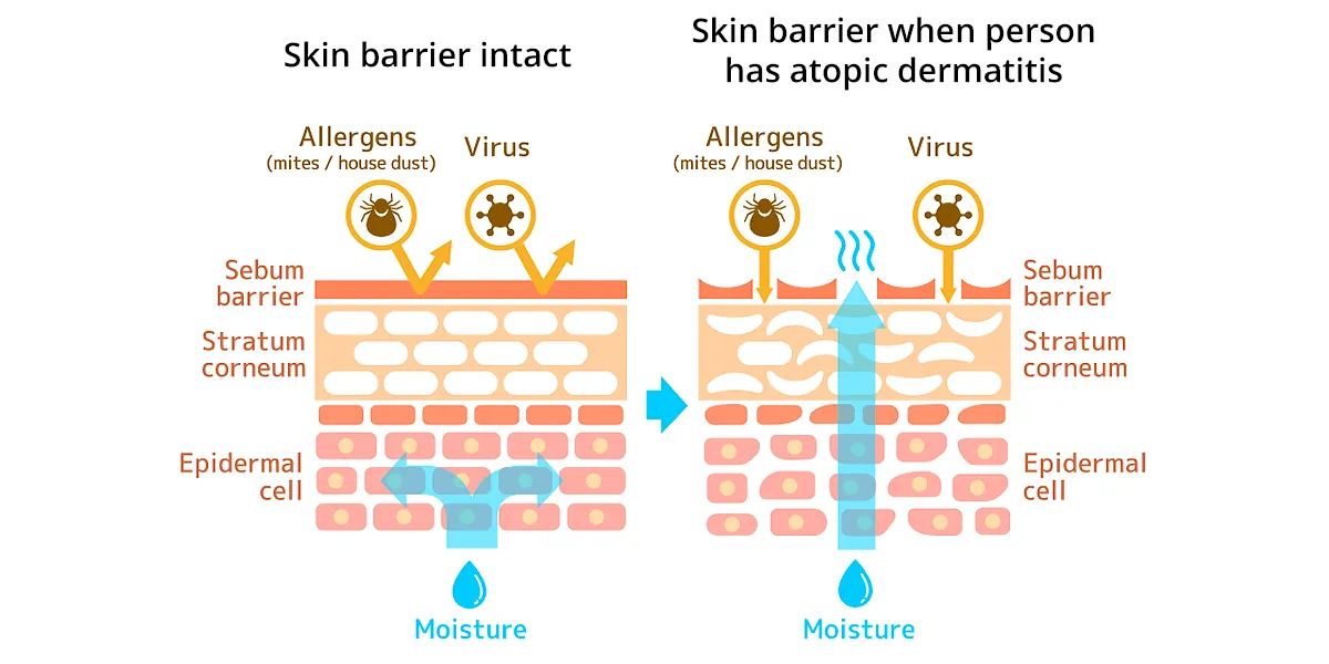 eczema farcas 1