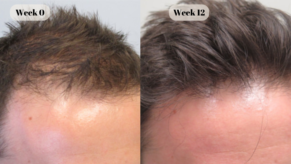 finasteride before and after (2)