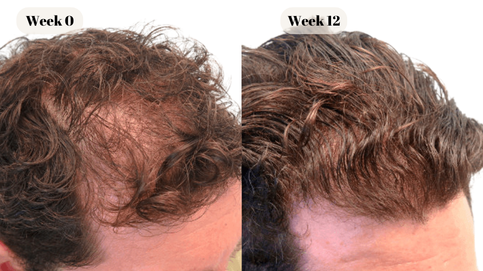 finasteride before and after (4)