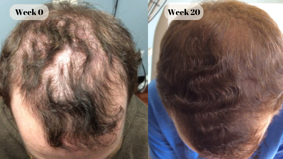 finasteride before and after (6)