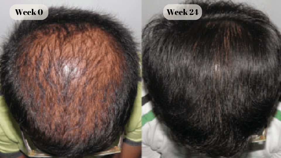 finasteride before and after