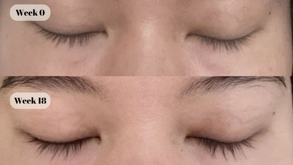 latisse before and after (2)