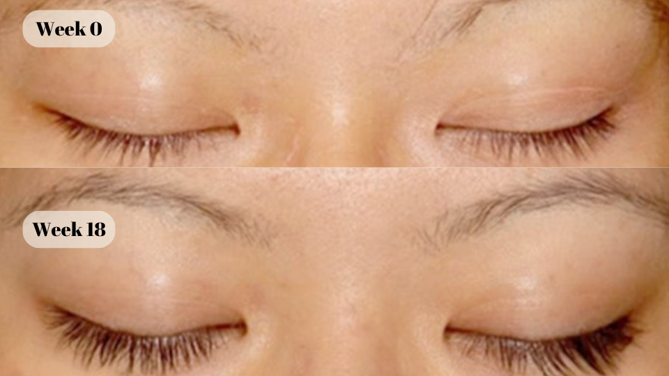 latisse before and after (3)